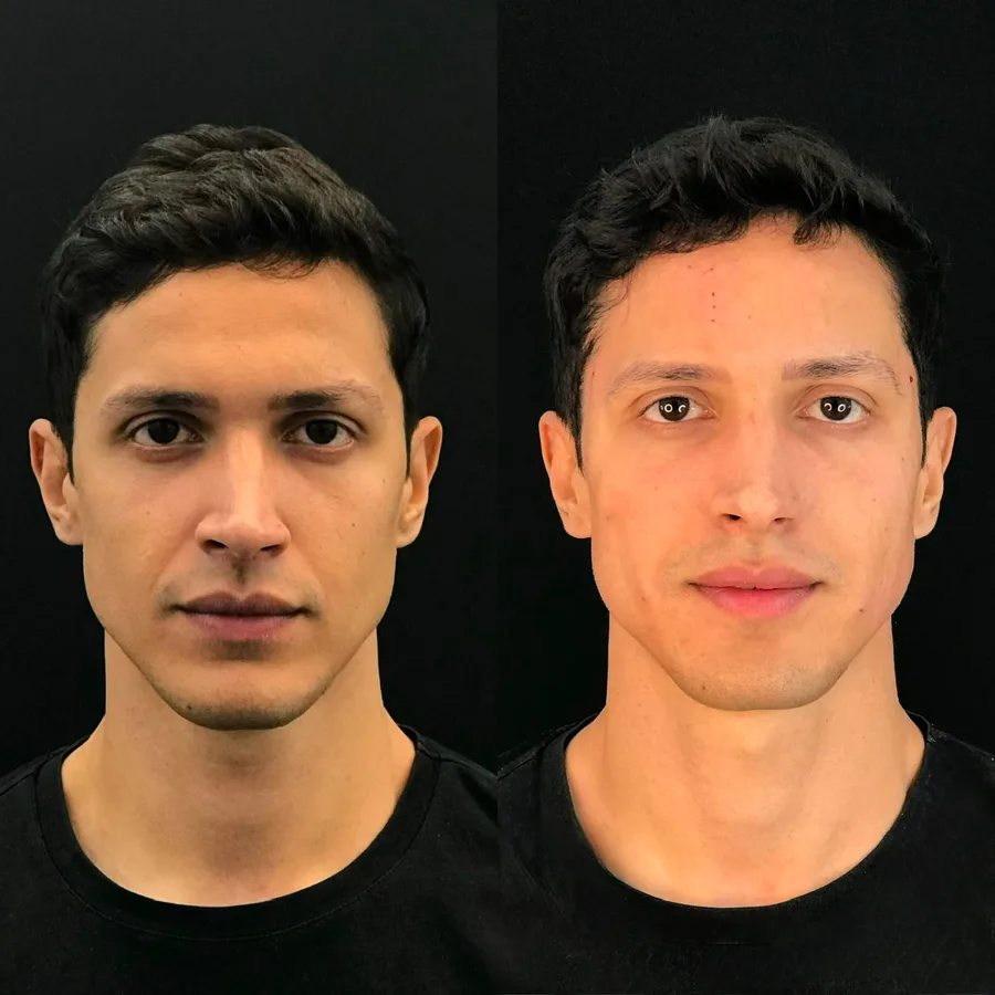 Resultado de fios de PDO com sustentação e firmeza facial
