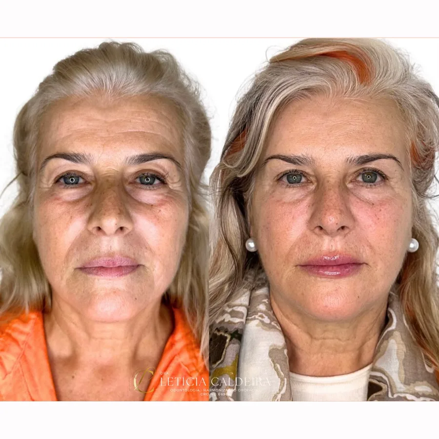 Resultado de harmonização facial Full Face com planejamento global da face