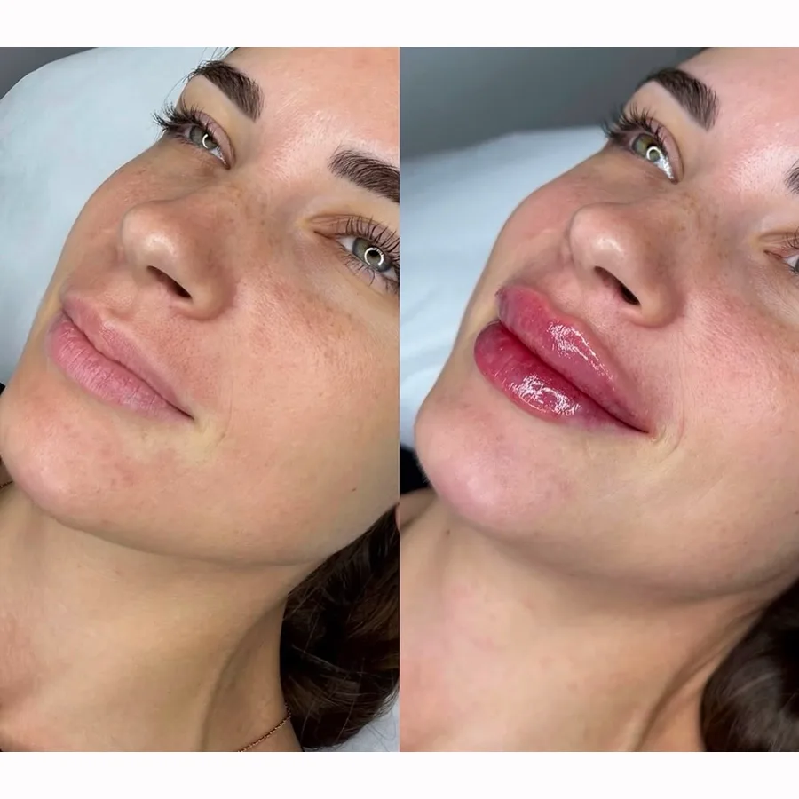 Resultado de preenchimento labial com foco em naturalidade