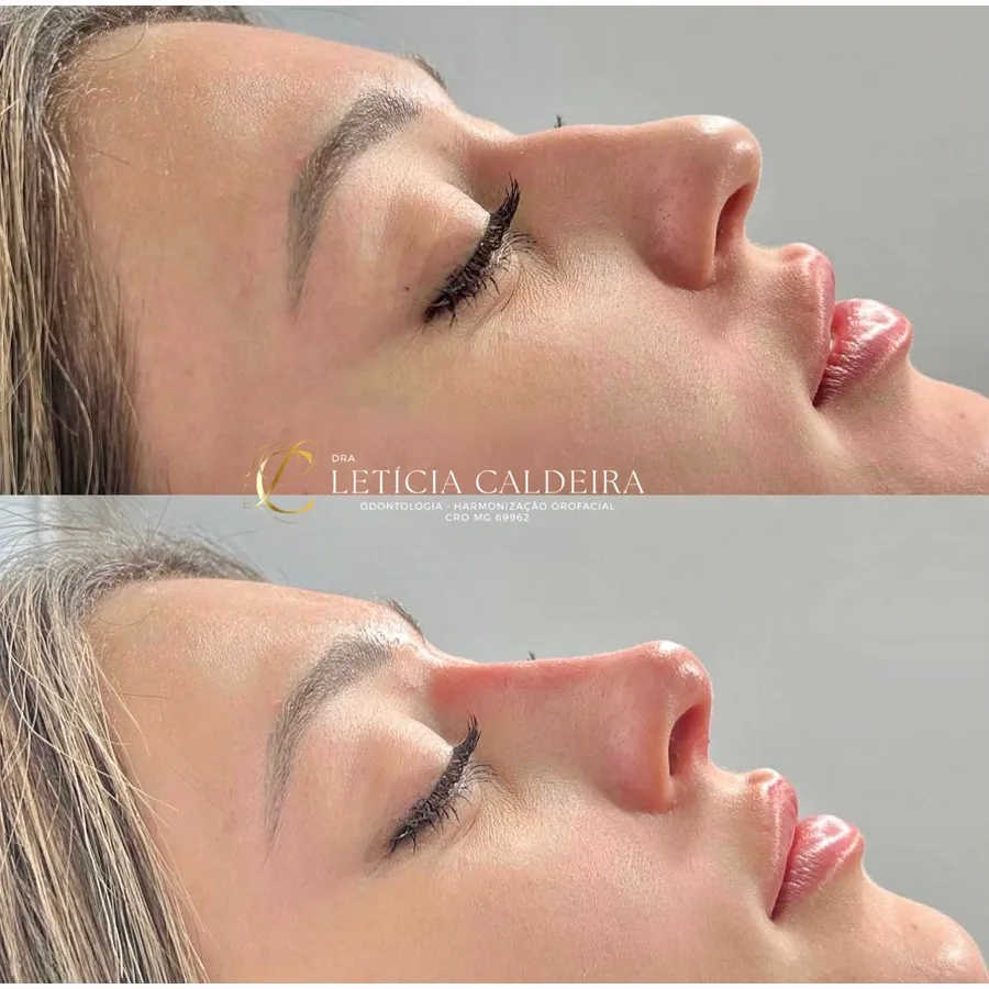 Resultado de rinomodelação com equilíbrio do perfil facial